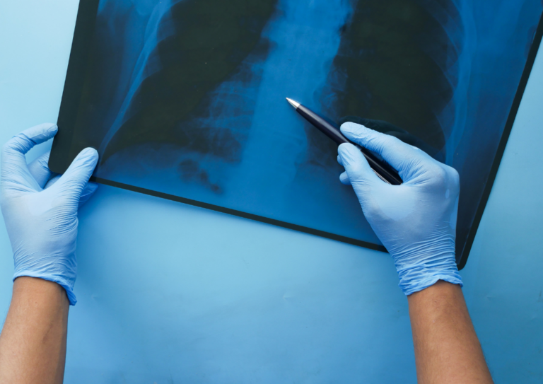 Rastreamento pulmonar é um aliado contra o câncer de pulmão rastreamento-pulmonar-e-um-aliado-contra-o-cancer-de-pulmao